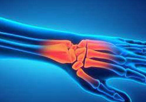 Hand- en polsklachten behandeling - Fysiotherapie